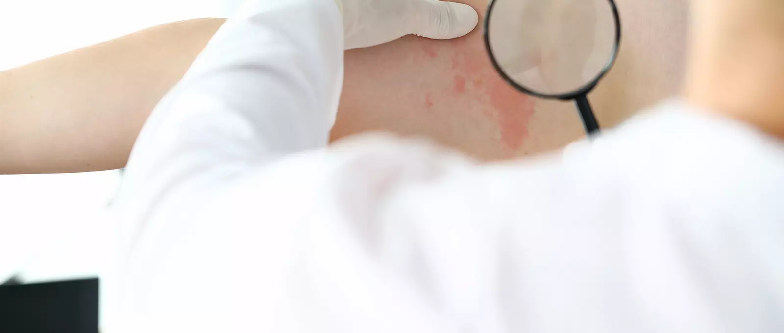 SJS Rash and Its Long-Term Impact: Legal Recourse for Those Affected by Severe Drug Reactions