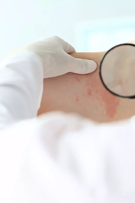 SJS Rash and Its Long-Term Impact: Legal Recourse for Those Affected by Severe Drug Reactions