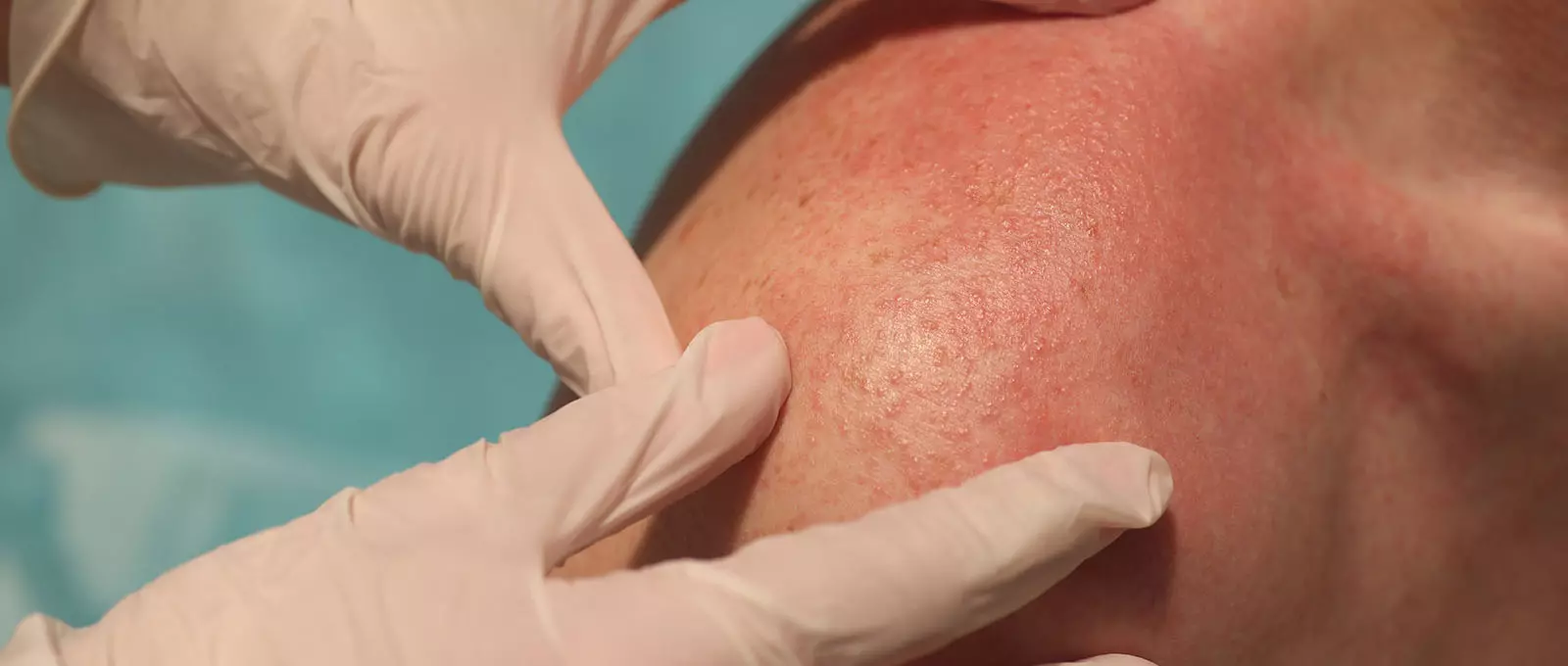 What Are the Long-Term Effects of Stevens-Johnson Syndrome?