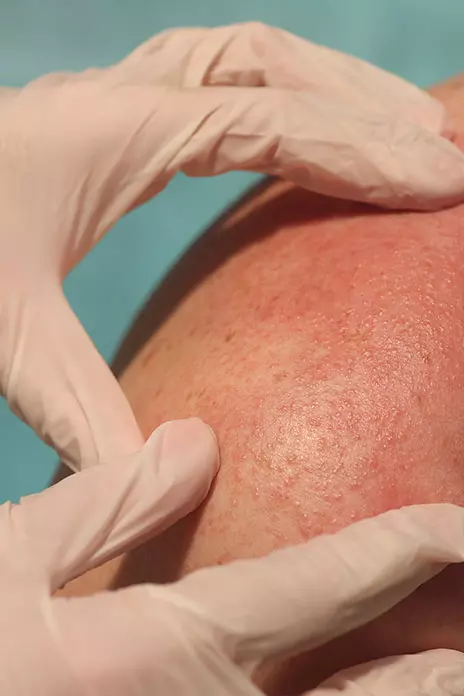 What Are the Long-Term Effects of Stevens-Johnson Syndrome?