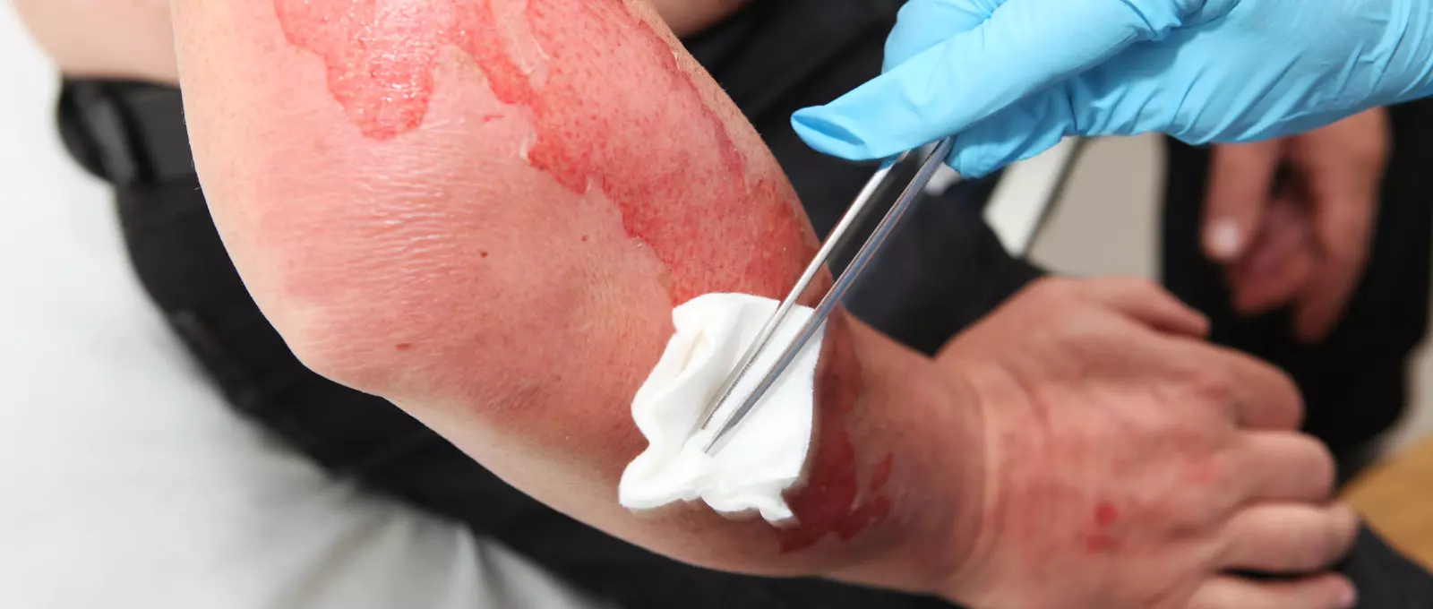 What is a Burn Injury Lawyer? | Comprehensive Guide