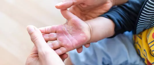 Understanding the Different Burn Injury Classifications