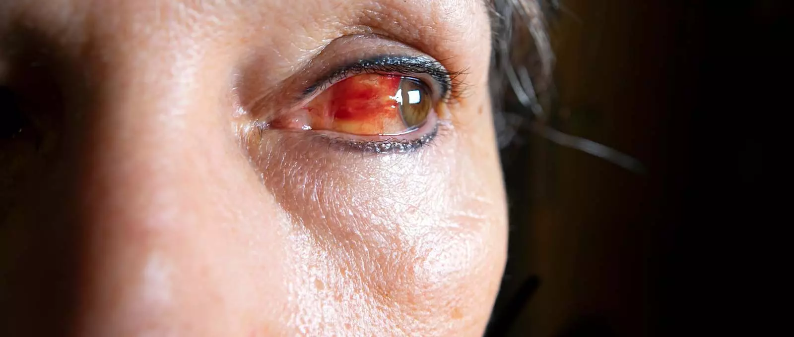 What Are Potential Ocular Stevens-Johnson Syndrome Symptoms?