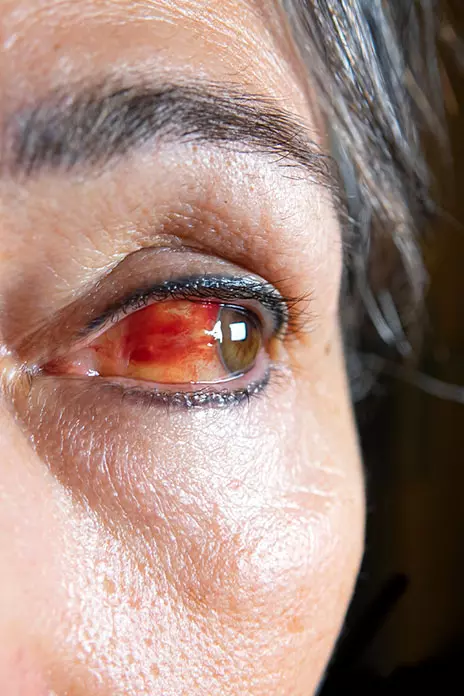 What Are Potential Ocular Stevens-Johnson Syndrome Symptoms?