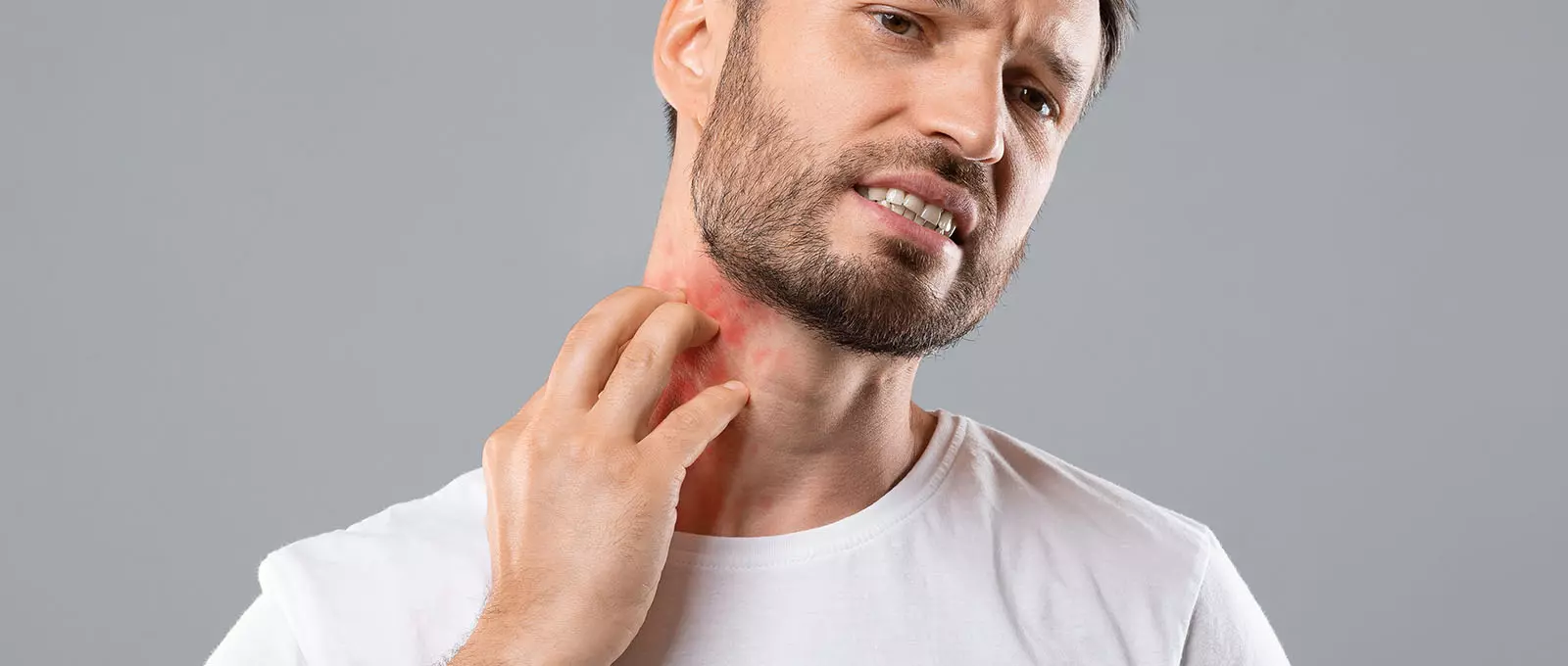 What Is the Survival Rate for Stevens-Johnson Syndrome?