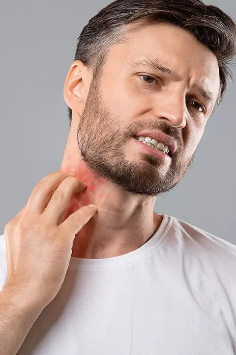 What Is the Survival Rate for Stevens-Johnson Syndrome?