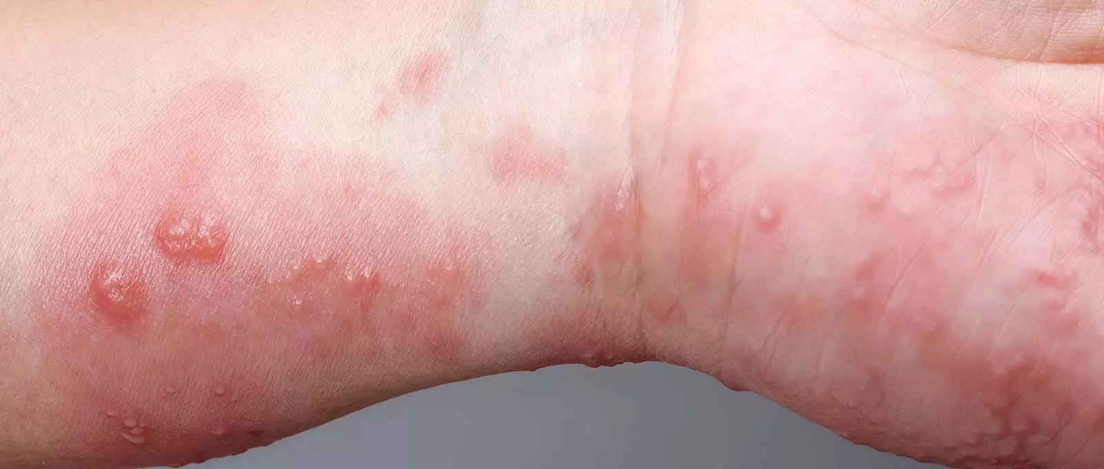 How Does the Stevens-Johnson Syndrome Rash Compare to Other Rashes?