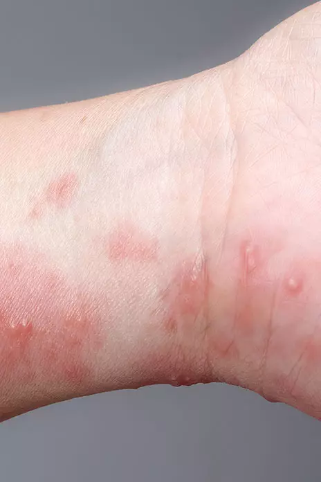 How Does the Stevens-Johnson Syndrome Rash Compare to Other Rashes?