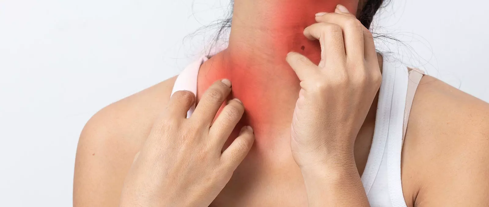 Stevens-Johnson Syndrome Symptoms: What Does the Rash Look Like?