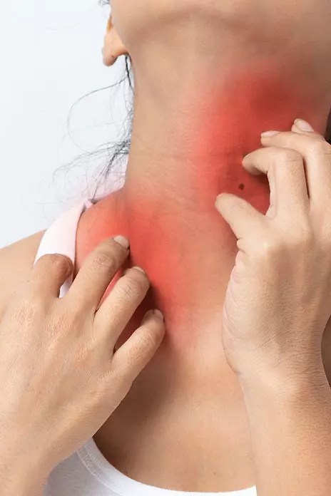 Stevens-Johnson Syndrome Symptoms: What Does the Rash Look Like?